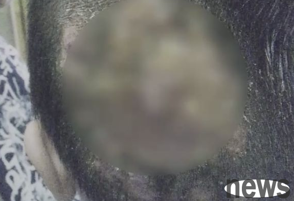 A 9-year-old girl has pussy after raising a cat. Doctor: Fungal infection may cause permanent hair loss